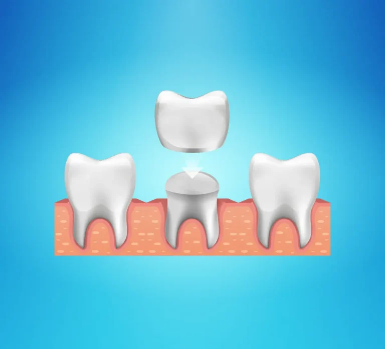 What to Do If Your Dental Crown Falls Out